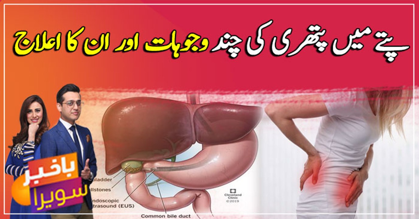 Some of the causes of gallstone and its cure