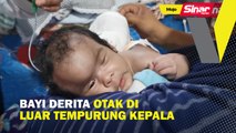 Bayi derita otak di luar tempurung kepala