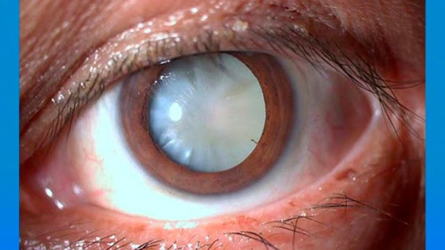 bd-causas-de-cataratas-oculares-220221