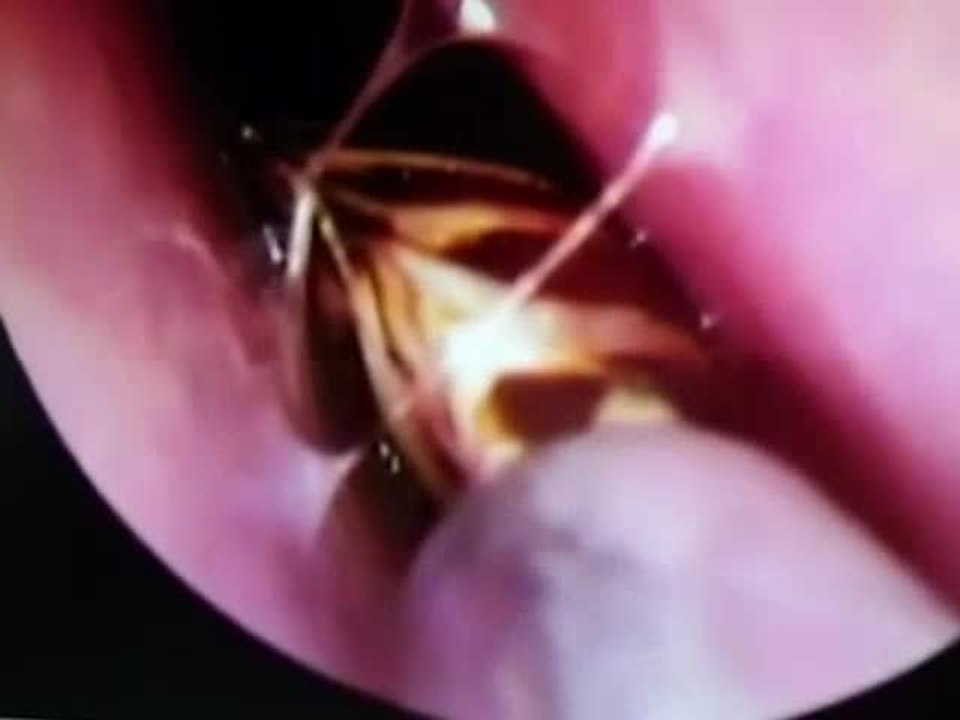 Doctors pull live cockroach from Indian woman's skull