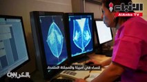 ذكاء اصطناعي منغوغليتفوق على الأطباء باكتشاف سرطان الثدي