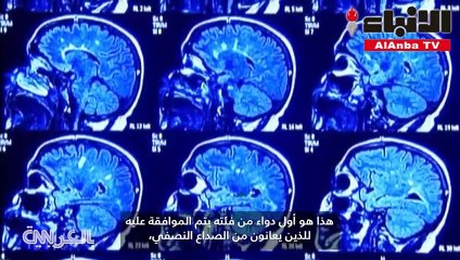 الصداع النصفي
