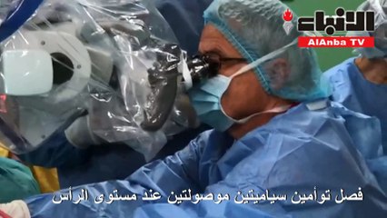 فصل توأمين سياميتين موصولتين عند مستوى الرأس في بنغلادش