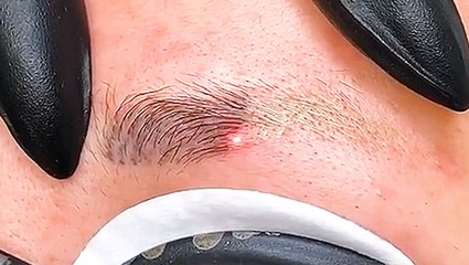 Laser treatment instantly removes permanent makeup