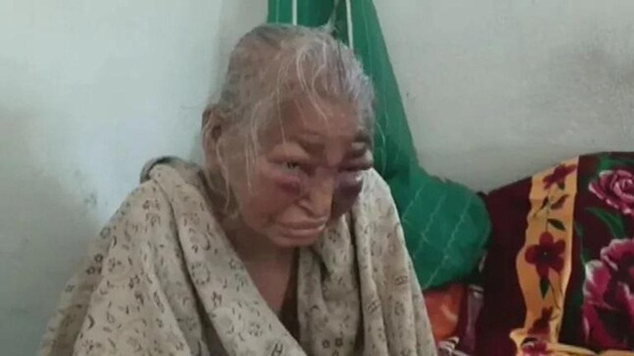 BJP alleges party worker's mother thrashed, TMC claims her face swollen due to ailment