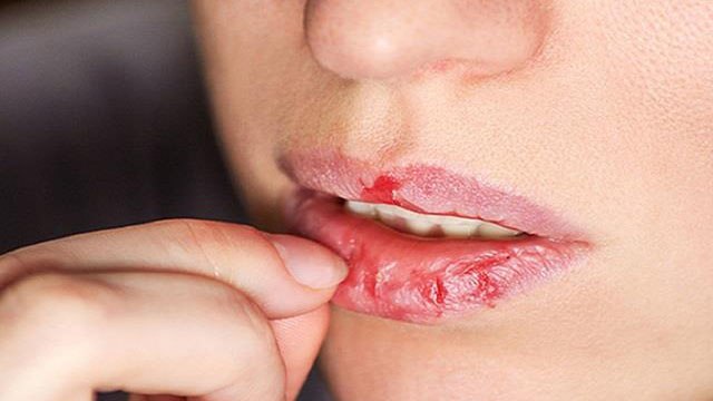 होंठ फटने के कारण। होंठ फटने से कैसे बचाएं । Chapped Lips Causes। Boldsky