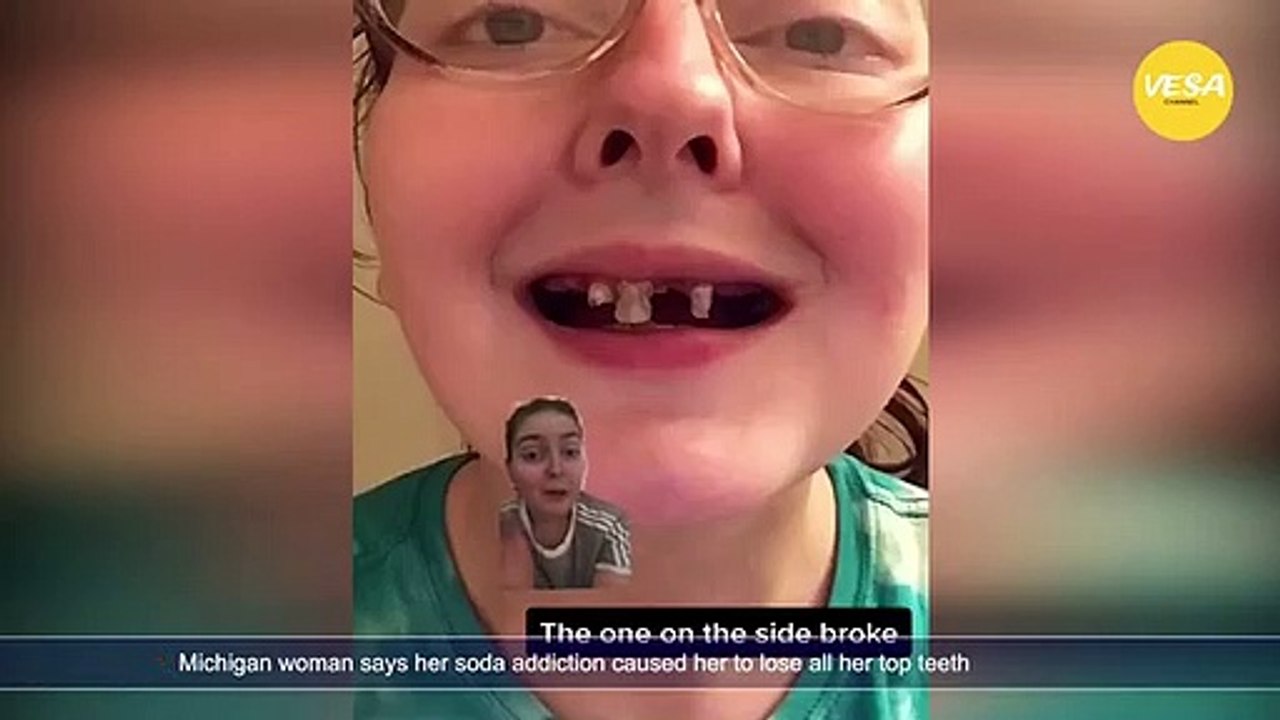 Michigan woman says her soda addiction caused her to lose all her top teeth