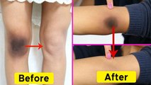 घुटने का कालापन आसानी से दूर करें | Knee Dark Spot Remover | Boldsky