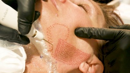 5 nonsurgical cosmetic procedures that will give you instant results