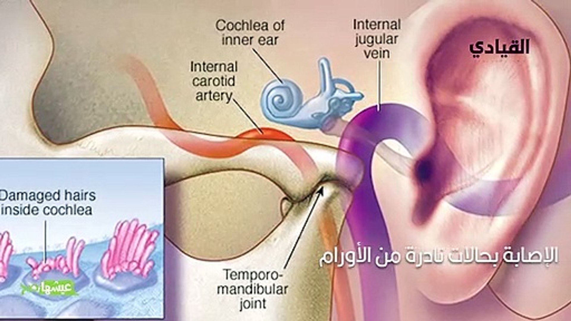 Гул в ухе лечение. Шум в ушах причины. Шум в ушах причины. Тиннитус шум в ушах. 3 марта международный день охраны здоровья уха и слуха.