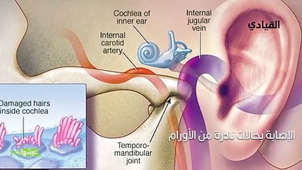 كيف تتخلص من طنين الأذن؟