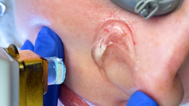 Watch this laser treatment instantly erase spider veins