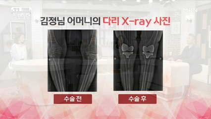 퇴행성 관절염 3기! 통증을 참지 말자! ( Ĭ ^ Ĭ )