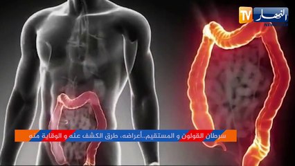 سرطان القولون والمستقيم.. أعراضه طرق الكشف عنه والوقاية منه