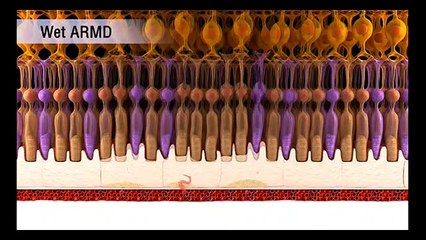Age Related Macular Degeneration (ARMD) Patient education & information