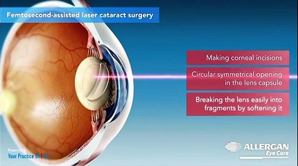 Information about Cataract surgery | Different Methods | Phaco Emulsification | Types of IOL lens implants | post-operative Care