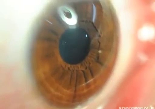 DRY EYE SYNDROME || हिंदी में In HINDI || Education & Information _Causes , Symptoms , Treatment.