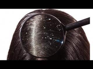 KETOMBEAN..!!! Ini Dia Cara Menghilangkannya Cuma Pake........