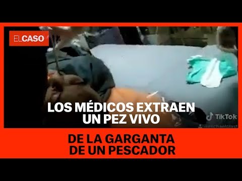 Los médicos extraen un pez vivo de la garganta de un pescador