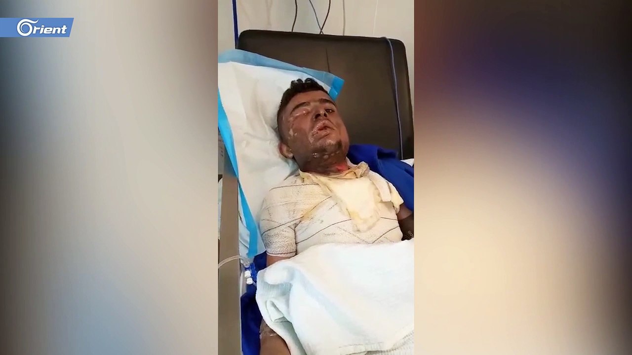تعرض شاب سوري في لبنان لحروق خطيرة نتيجة قيام عدد من الشبان بإلقاء مادة حارقة عليه