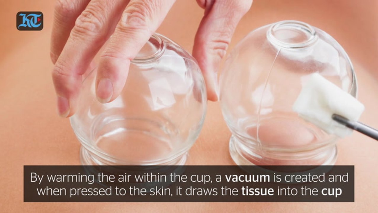 Cupping In Dubai just got safer
