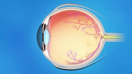 bd-aclaramos-sus-dudas-sobre-el-glaucoma-120321