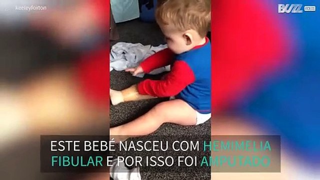 Bebé coloca prótese pela primeira vez sozinho