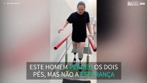 Homem com os dois pés amputados volta a andar 1