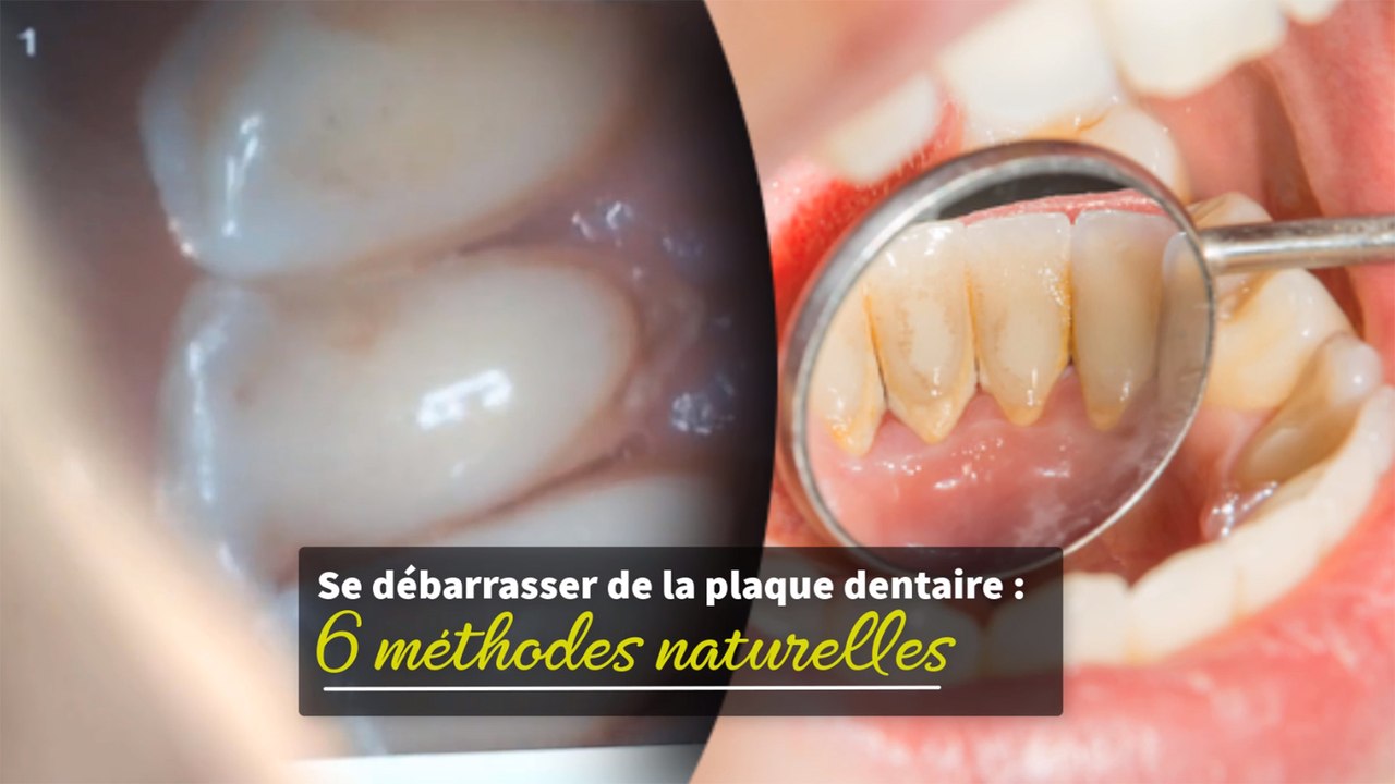 Se débarrasser de la plaque dentaire : 6 méthodes naturelles