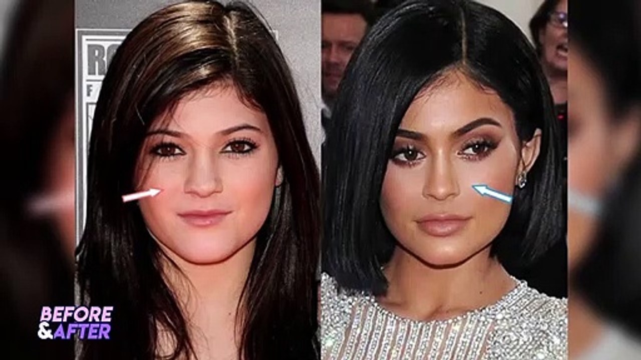 Kylie Jenner Plastic Surgery Transformation 2025r 2025 