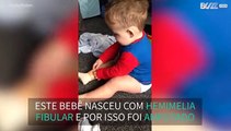 Bebê coloca prótese pela primeira vez sozinho