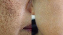 15 मिनट करें ये काम दूर हो जाएंगे चेहरे की झाइयां | Skin Care Remedies for Wrinkles | Boldsk