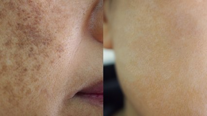 15 मिनट करें ये काम दूर हो जाएंगे चेहरे की झाइयां | Skin Care Remedies for Wrinkles | Boldsk