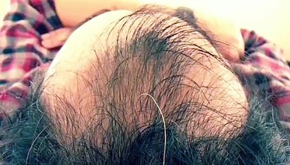 Hair growth, TENS machine, micro electricity, Nano currents