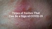 8 Types of Rashes That Can Be a Sign of COVID-19