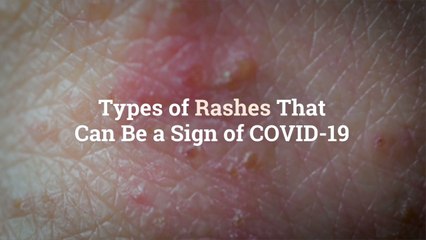 Video herunterladen: 8 Types of Rashes That Can Be a Sign of COVID-19