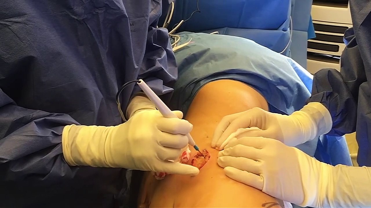 Reconstruction mammaire immédiate complète en un seul temps opératoire