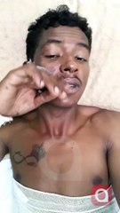 Trabalhador vítima de queimaduras agradece atendimento médido