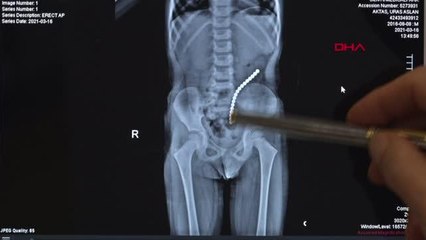 KÜÇÜK URAS'IN KARIN AĞRISININ NEDENİ HERKESİ ŞAŞIRTTI; BAĞIRSAĞINDAN 19 MIKNATIS ÇIKTI