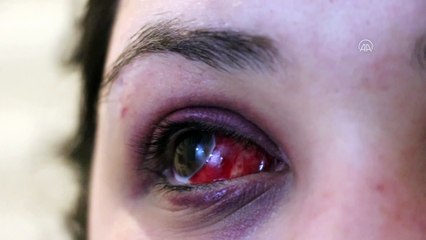 KARABÜK - Bir kadın kendisini darbettiği iddiasıyla avukat erkek arkadaşından şikayetçi oldu