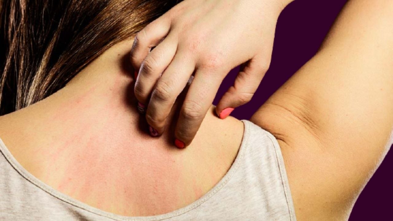 गर्मी में खुजली की दिक्कत से निजात पाने के लिए...