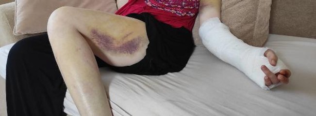 İZMİR'DE ERKEK ARKADAŞI TARAFINDAN BEYZBOL SOPASIYLA DÖVÜLEN KADIN YAŞADIKLARINI ANLATTI