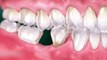 bd-perdida-de-piezas-dentales-220321
