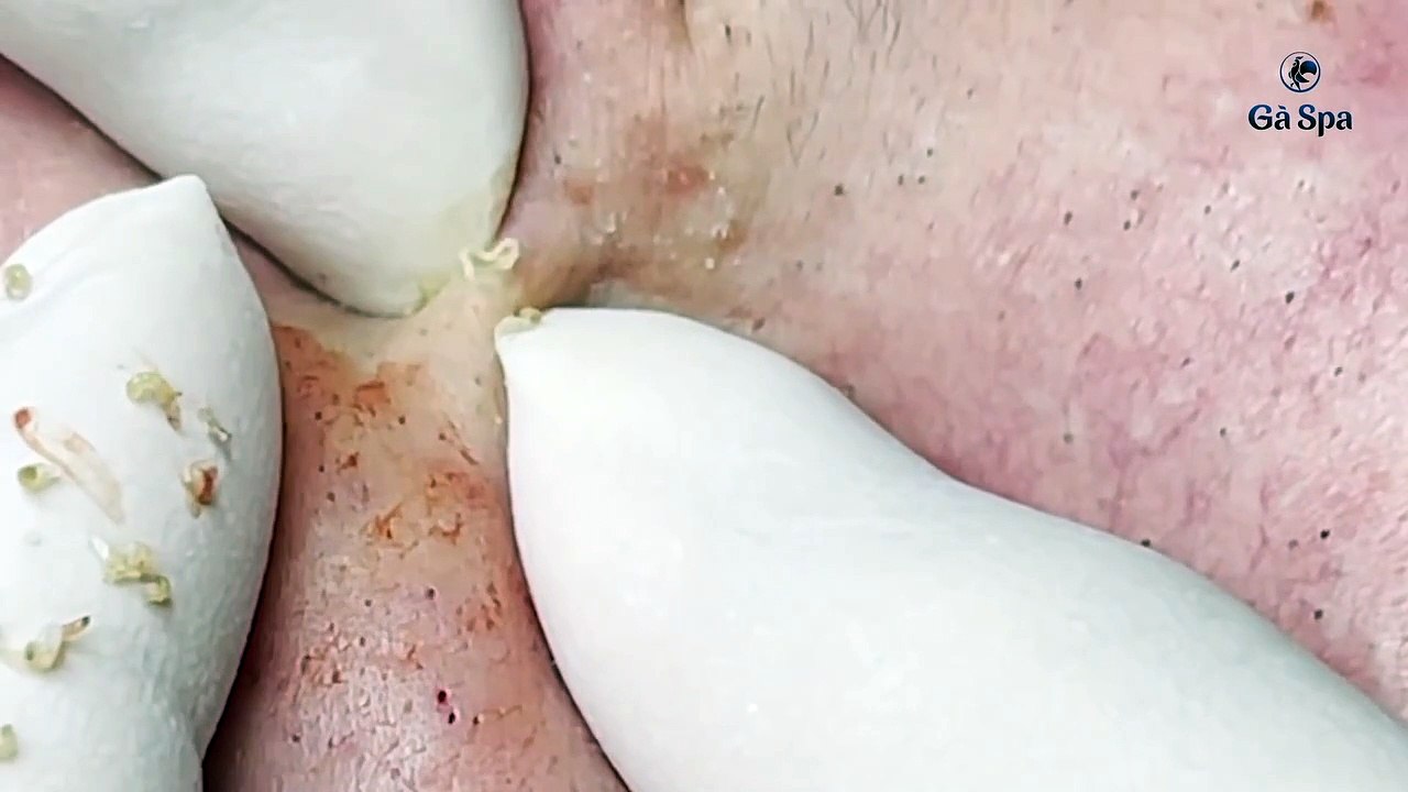Big Cystic Acne Blackheads Extraction Blackhead...