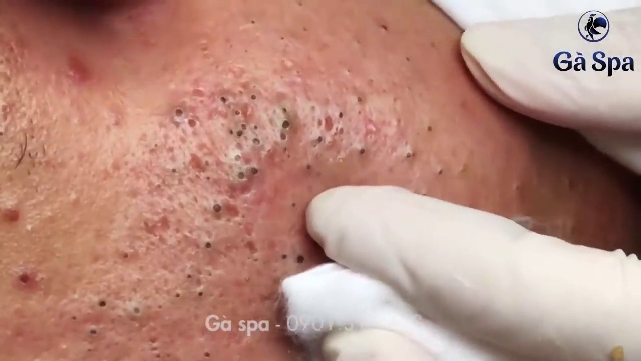Big Cystic Acne Blackheads Extraction Blackheads & Milia, Whiteheads Removal Pimple Popping S005