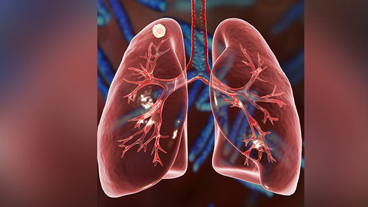 World Tuberculosis Day 2021: टीबी रोग के इलाज का जबरदस्त तरीका | TB ke ilaj ka tarika | Boldsky