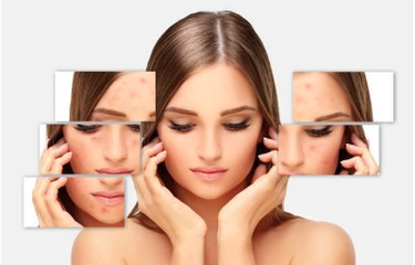 How to Prevent Acne With These Easy Tips