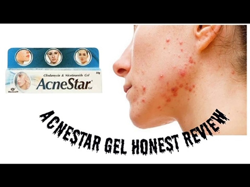 AcneStar gel review | best medicated gel for acne