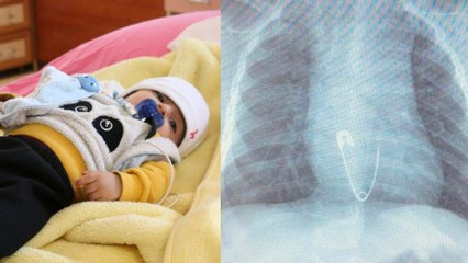 5 aylık bebeğin yemek borusundan çıkarıldı