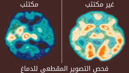 تعرفوا على الاكتئاب وكيف يمكن ان نشخصه نعالجه